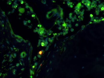 Stammzellen und Krebs – neue Ideen für die Therapie