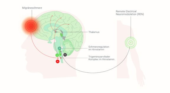 REN – Neue Neuromodulations-Therapie bei Migräne – Pressemappe zur Fachpressekonferenz